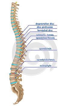 Damaged spine. Infographics of various back diseases. photo